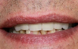 Smile Gallery - Church Road Dental and Cosmetic