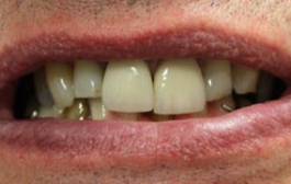 Smile Gallery - Church Road Dental and Cosmetic