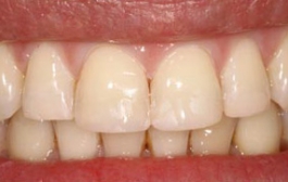 Smile Gallery - Church Road Dental and Cosmetic