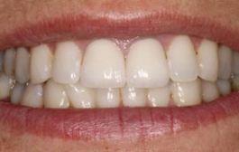 Smile Gallery - Church Road Dental and Cosmetic
