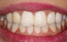 Smile Gallery - Church Road Dental and Cosmetic