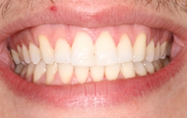 Smile Gallery - Church Road Dental and Cosmetic