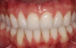 Smile Gallery - Church Road Dental and Cosmetic