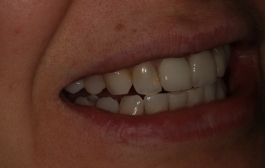 Smile Gallery - Church Road Dental and Cosmetic