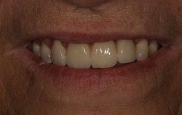Smile Gallery - Church Road Dental and Cosmetic