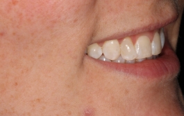 Smile Gallery - Church Road Dental and Cosmetic
