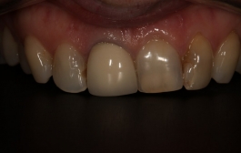 Smile Gallery - Church Road Dental and Cosmetic