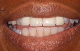 Smile Gallery - Church Road Dental and Cosmetic