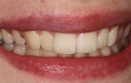 Smile Gallery - Church Road Dental and Cosmetic