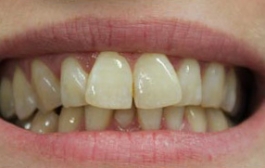 Smile Gallery - Church Road Dental and Cosmetic