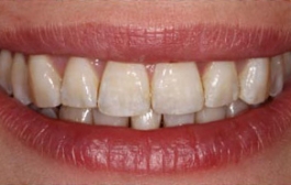 Smile Gallery - Church Road Dental and Cosmetic