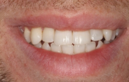Smile Gallery - Church Road Dental and Cosmetic