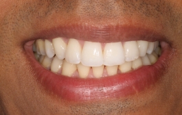 Smile Gallery - Church Road Dental and Cosmetic
