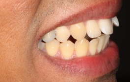 Smile Gallery - Church Road Dental and Cosmetic