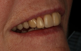 Smile Gallery - Church Road Dental and Cosmetic
