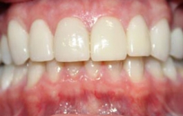 Smile Gallery - Church Road Dental and Cosmetic