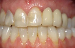 Smile Gallery - Church Road Dental and Cosmetic