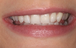 Smile Gallery - Church Road Dental and Cosmetic