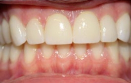 Smile Gallery - Church Road Dental and Cosmetic