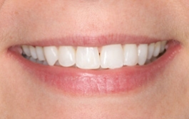 Smile Gallery - Church Road Dental and Cosmetic