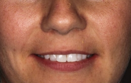 Smile Gallery - Church Road Dental and Cosmetic