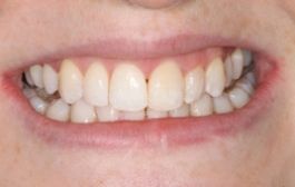 Smile Gallery - Church Road Dental and Cosmetic