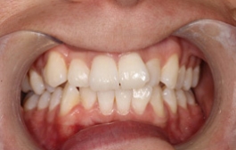 Smile Gallery - Church Road Dental and Cosmetic