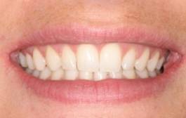 Smile Gallery - Church Road Dental and Cosmetic