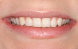 Smile Gallery - Church Road Dental and Cosmetic