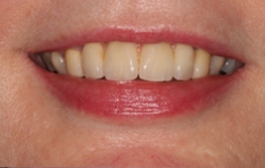 Smile Gallery - Church Road Dental and Cosmetic