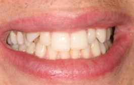 Smile Gallery - Church Road Dental and Cosmetic