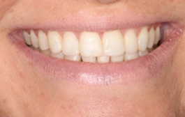 Smile Gallery - Church Road Dental and Cosmetic