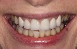 Smile Gallery - Church Road Dental and Cosmetic