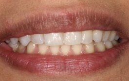 Smile Gallery - Church Road Dental and Cosmetic