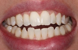 Smile Gallery - Church Road Dental and Cosmetic