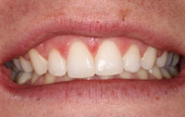 Smile Gallery - Church Road Dental and Cosmetic