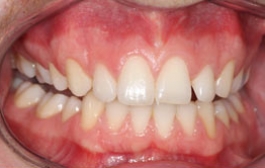 Smile Gallery - Church Road Dental and Cosmetic