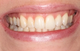 Smile Gallery - Church Road Dental and Cosmetic