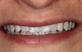 Smile Gallery - Church Road Dental and Cosmetic