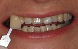 Smile Gallery - Church Road Dental and Cosmetic