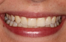 Smile Gallery - Church Road Dental and Cosmetic