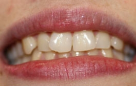 Smile Gallery - Church Road Dental and Cosmetic