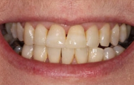 Smile Gallery - Church Road Dental and Cosmetic