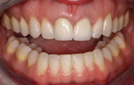 Smile Gallery - Church Road Dental and Cosmetic