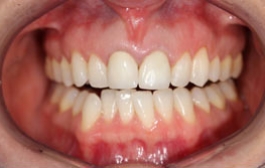 Smile Gallery - Church Road Dental and Cosmetic