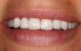 Smile Gallery - Church Road Dental and Cosmetic