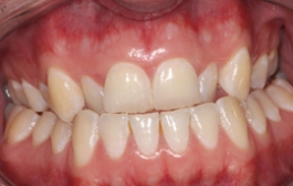 Smile Gallery - Church Road Dental and Cosmetic