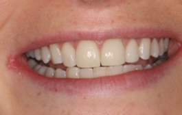 Smile Gallery - Church Road Dental and Cosmetic