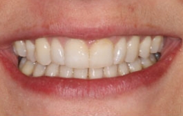Smile Gallery - Church Road Dental and Cosmetic