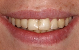 Smile Gallery - Church Road Dental and Cosmetic